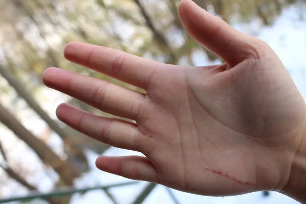 palm with lacerations caused by surfing